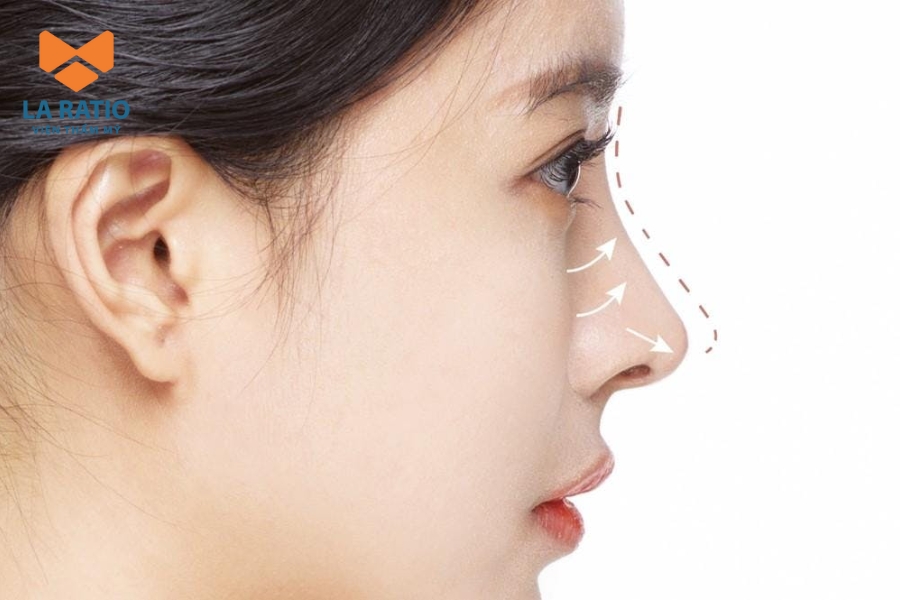 Phương pháp khắc phục tướng mũi phù thủy tại La Ratio Phương pháp khắc phục tướng mũi phù thủy tại La Ratio