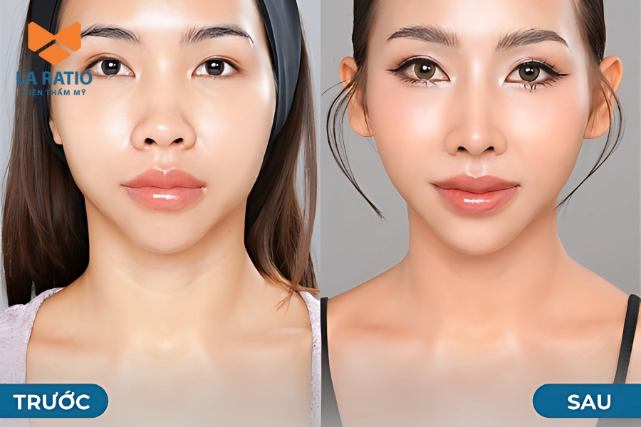 Quy trình sửa mũi phù thủy tại La Ratio Quy trình sửa mũi phù thủy tại La Ratio