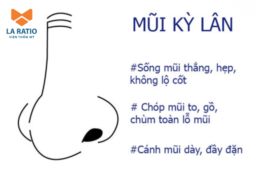 Mũi kỳ lân là gì? Đây là dáng mũi có đầu mũi to, cánh mũi to bè