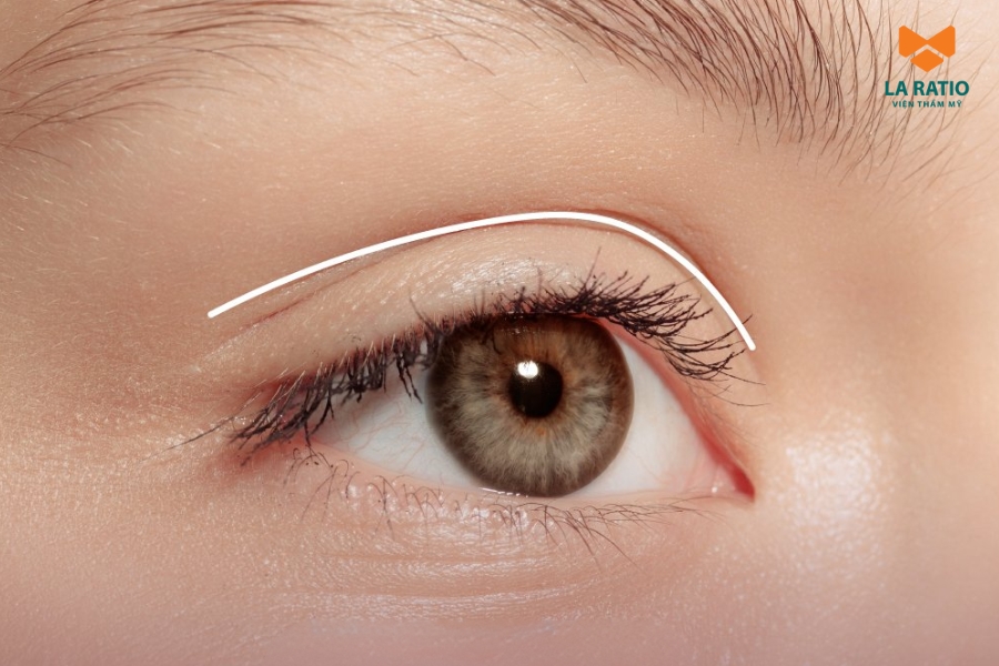 Các giai đoạn hồi phục sau cắt mí mắt Các giai đoạn hồi phục sau cắt mí mắt