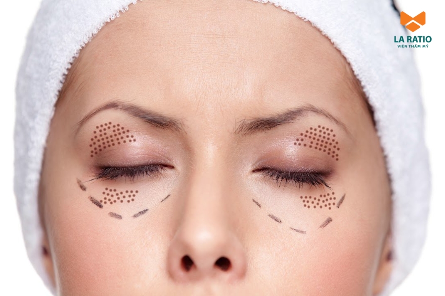 Tiêu chí đánh giá cắt mí ở đâu an toàn và đẹp tự nhiên