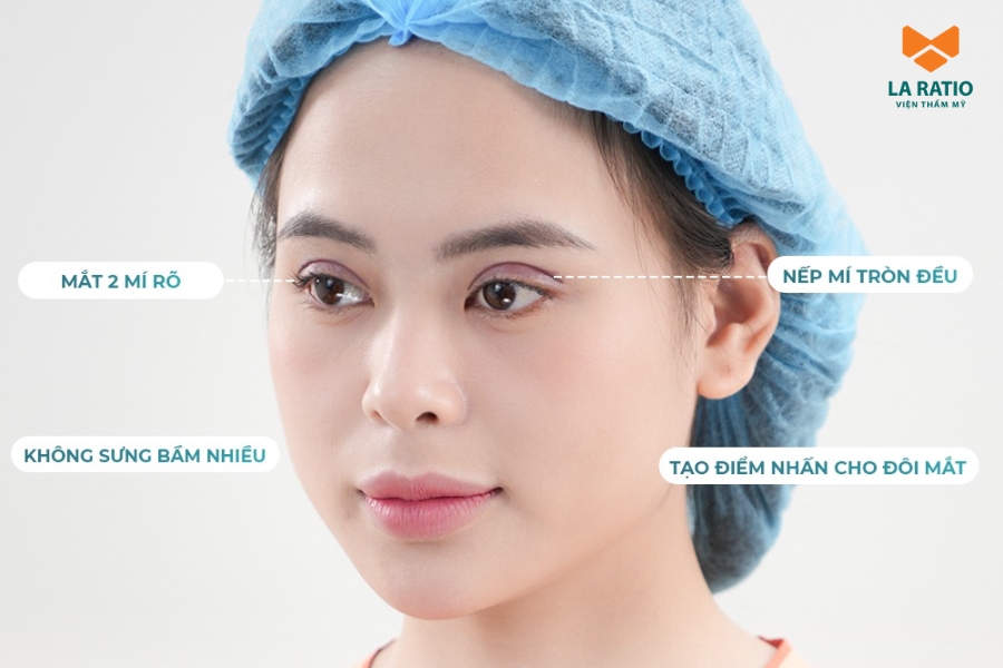 Công nghệ cắt mí ILID giúp mí mắt nhanh hồi phục - hạn chế sưng bầm Công nghệ cắt mí ILID giúp mí mắt nhanh hồi phục - hạn chế sưng bầm