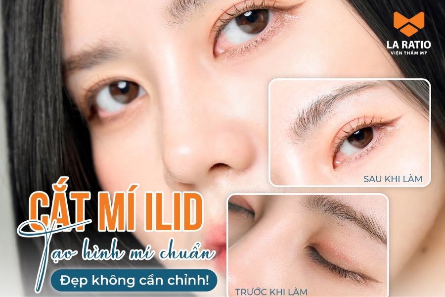 Cắt mắt ILID tại La Ratio - Đẹp tự nhiên chỉ sau 30 phút Cắt mắt ILID tại La Ratio - Đẹp tự nhiên chỉ sau 30 phút