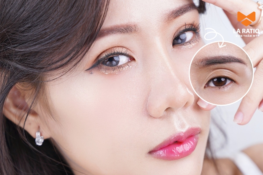 Cắt mí bao nhiêu tiền? Giá cắt mí dao động từ 7 - 30 triệu Cắt mí bao nhiêu tiền? Giá cắt mí dao động từ 7 - 30 triệu