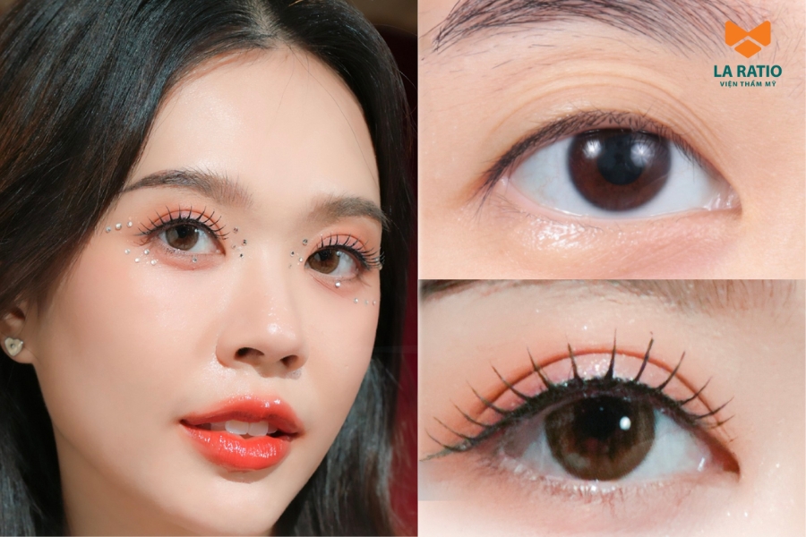 Cắt mí mấy tháng thì đẹp? Thông thường là sau 1 - 3 tháng Cắt mí mấy tháng thì đẹp? Thông thường là sau 1 - 3 tháng