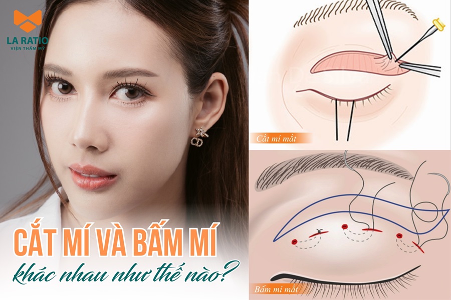 Cắt mí và bấm mí khác nhau như thế nào? Nên cắt mí hay bấm mí?