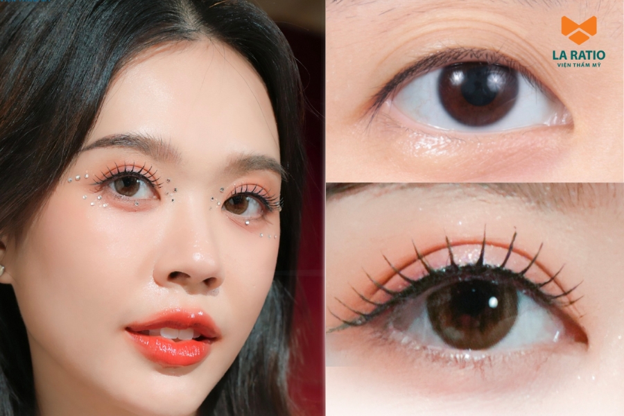 Đôi mắt to tròn, đầy cuốn hút là kết quả khách hàng nhận được khi lựa chọn cắt mí ILID tại La Ratio