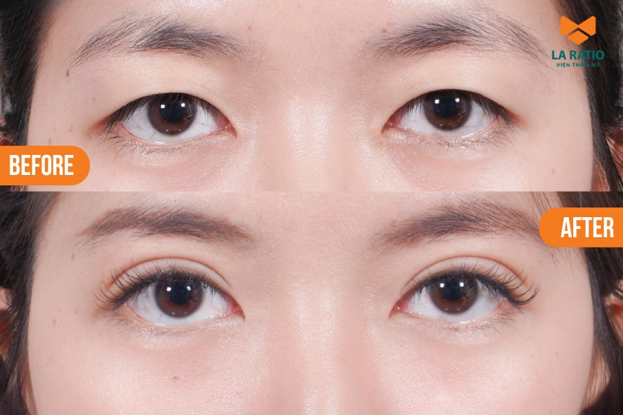 Sau cắt mí tại La Ratio, khách hàng nhanh chóng sở hữu đôi mắt 2 mí rõ nét, tự nhiên