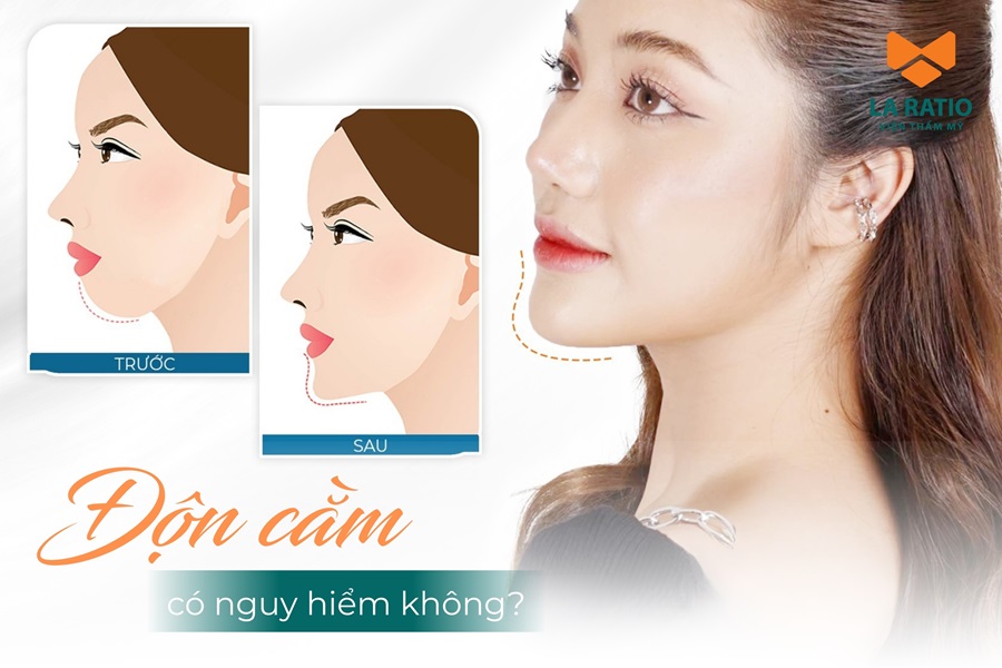Độn cằm có nguy hiểm không? Có để lại biến chứng gì không?