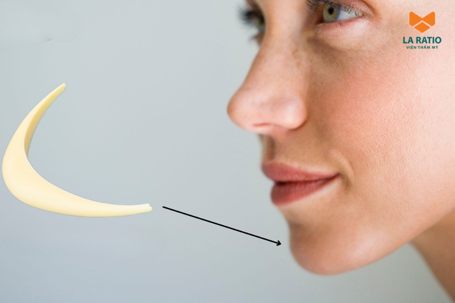 Độn cằm có nguy hiểm không? Đây là phương pháp làm đẹp an toàn nếu được thực hiện tại cơ sở uy tín