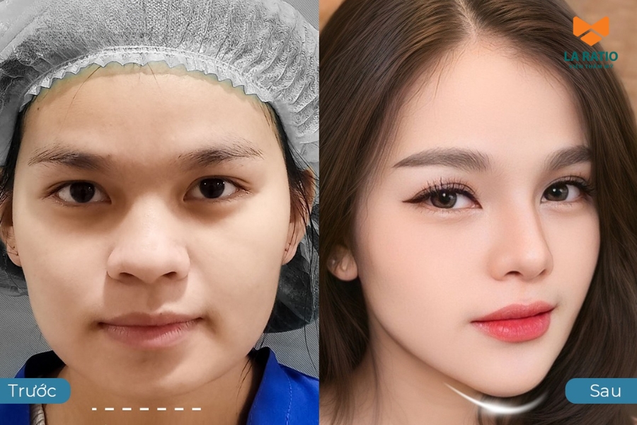 Độn cằm BIOMAT hạn chế đau - hạn chế sưng bầm tại La Ratio