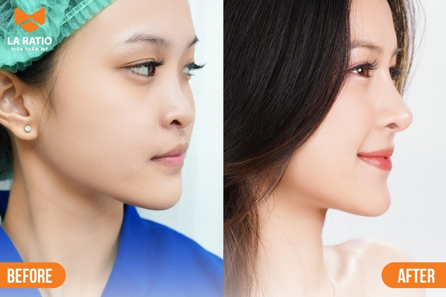 Nâng mũi không băng nẹp - Chỉ 1 tiếng là đẹp tại La Ratio