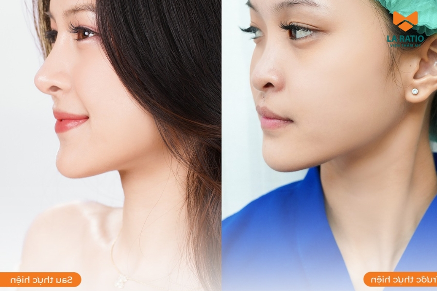 Sau 2 tuần, dáng mũi mới đã thanh tú, tự nhiên như chưa từng chỉnh sửa Sau 2 tuần, dáng mũi mới đã thanh tú, tự nhiên như chưa từng chỉnh sửa