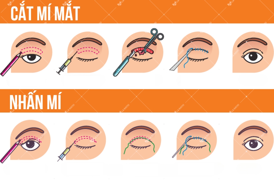 Giữa cắt mí và bấm mí không có phương pháp nào đẹp hơn, chỉ có phương pháp phù hợp nhất