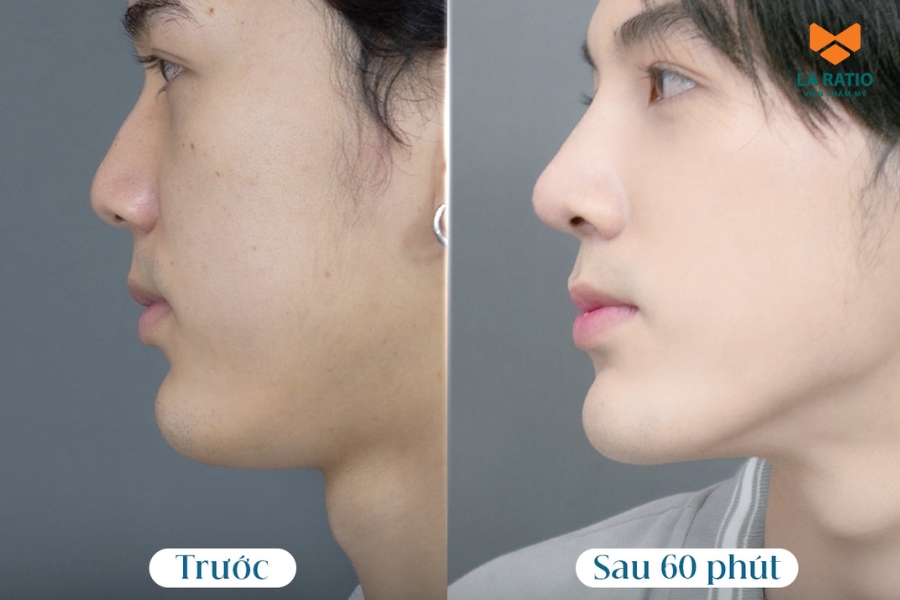 Mỗi dáng mũi được Bác sĩ Võ Thành Trung thiết kế riêng, phù hợp với từng gương mặt nam giới