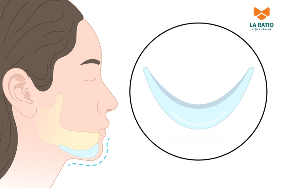 Độn cằm sẽ không gây đau do tác dụng của thuốc tê