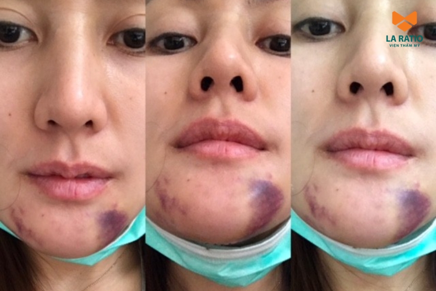 Các biến chứng thường gặp khi phẫu thuật độn cằm