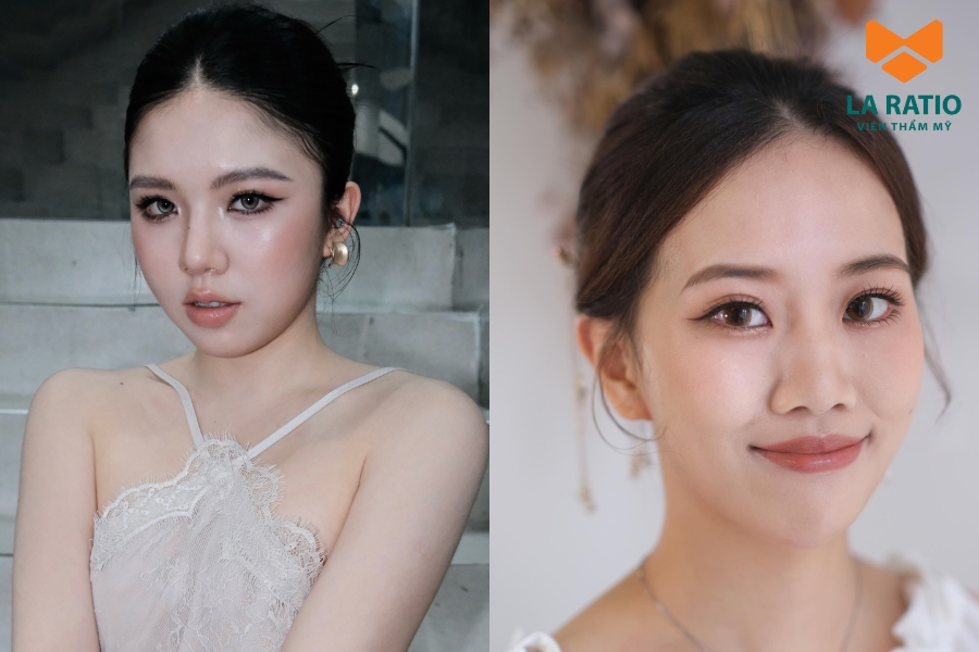 Bạn nên thăm khám với bác sĩ để quyết định có nên cắt mắt Trung Hoa không