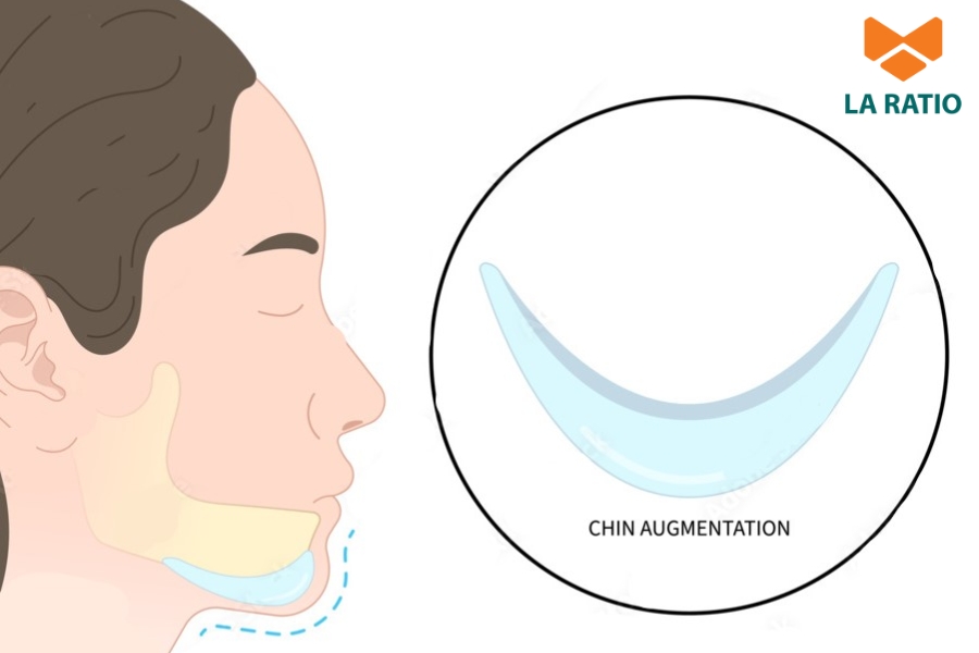 Độn cằm phù hợp với những trường hợp cằm có ít khuyết điểm
