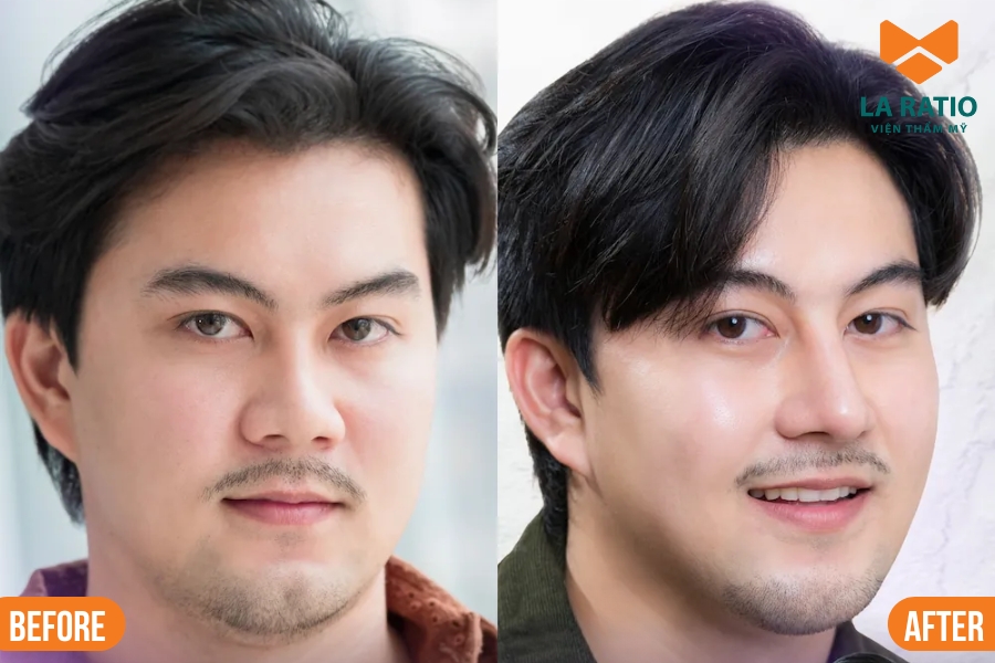 Nam giới mặt vuông phù hợp với mũi L-Line hoặc cao tây, giúp gương mặt cân đối và giữ nét nam tính