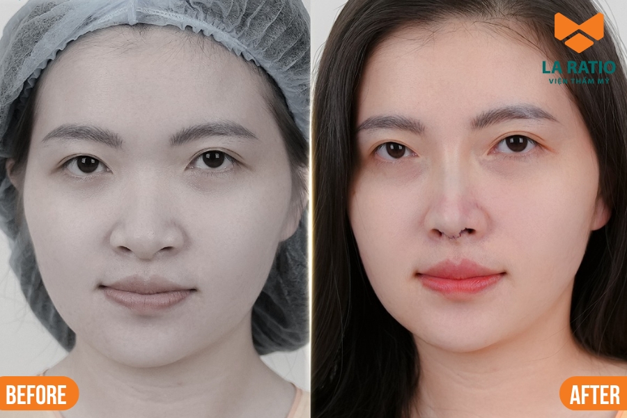 Nâng mũi S-Line giúp gương mặt vuông của nữ giới trở nên thanh thoát và mềm mại hơn