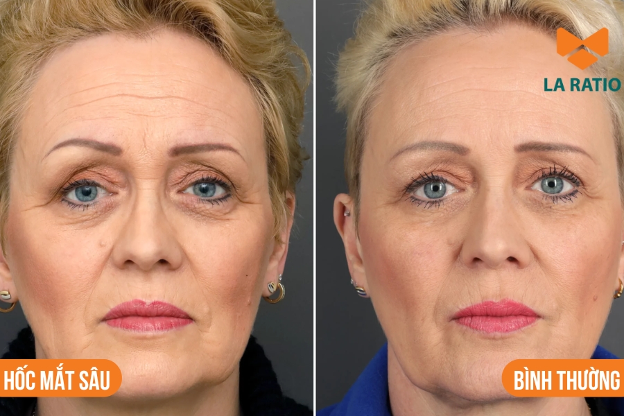 Hốc mắt sâu là tình trạng phần mắt bị trũng sâu hơn so với bình thường Hốc mắt sâu là tình trạng phần mắt bị trũng sâu hơn so với bình thường