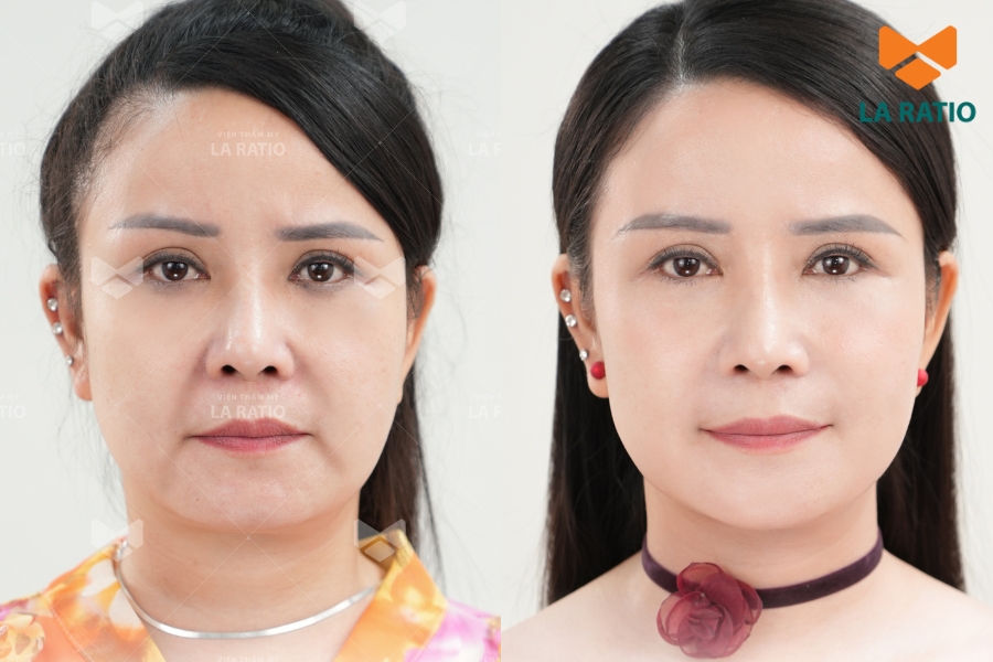 Thay đổi nhẹ nhàng, hiệu quả rõ rệt - Ultra Young giúp gương mặt tươi trẻ và săn chắc hơn. Thay đổi nhẹ nhàng, hiệu quả rõ rệt - Ultra Young giúp gương mặt tươi trẻ và săn chắc hơn.