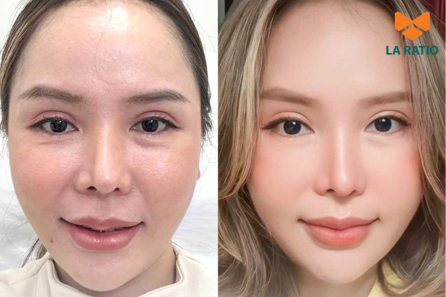 Khách hàng lấy lại đường nét gương mặt săn chắc, căng mịn và rạng rỡ chỉ sau một liệu trình Ultra Young Khách hàng lấy lại đường nét gương mặt săn chắc, căng mịn và rạng rỡ chỉ sau một liệu trình Ultra Young