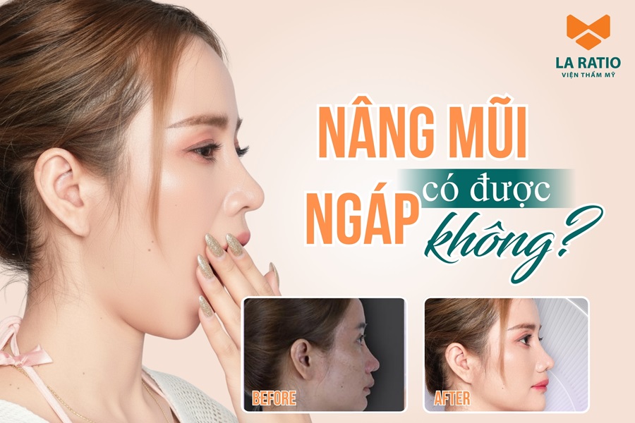 Nâng mũi có được ngáp không? Lời khuyên từ chuyên gia La Ratio