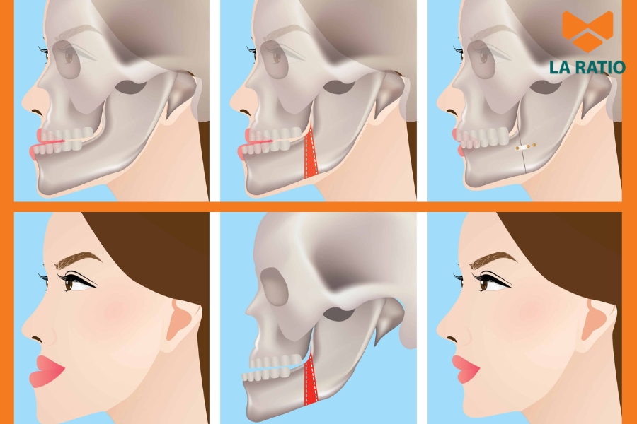 Bạn nên gọt cằm khi cấu trúc xương hàm hoặc dáng cằm hiện tại khiến khuôn mặt mất cân đối Bạn nên gọt cằm khi cấu trúc xương hàm hoặc dáng cằm hiện tại khiến khuôn mặt mất cân đối