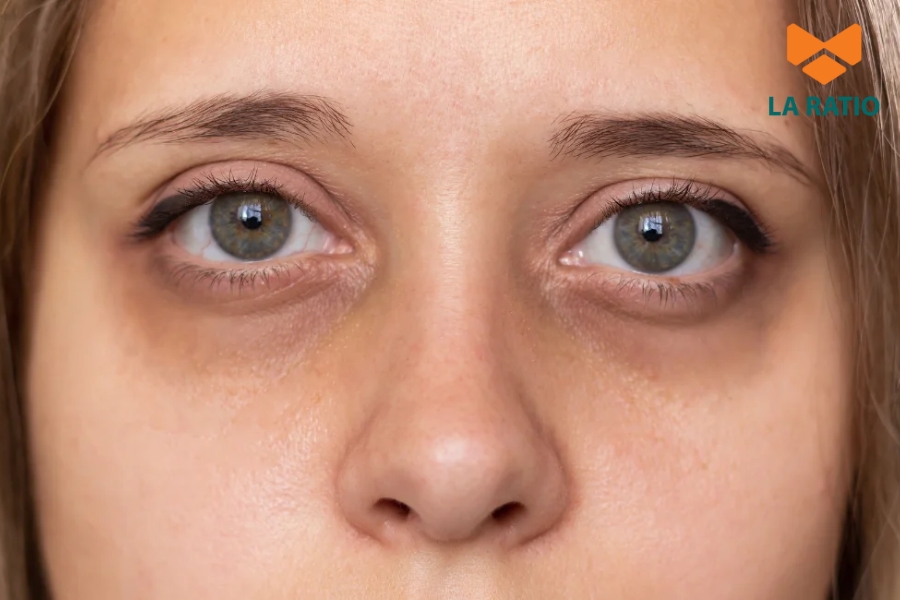 Phần lớn nguyên nhân khiến mắt bị cắt quá sâu là do tay nghề bác sĩ Phần lớn nguyên nhân khiến mắt bị cắt quá sâu là do tay nghề bác sĩ