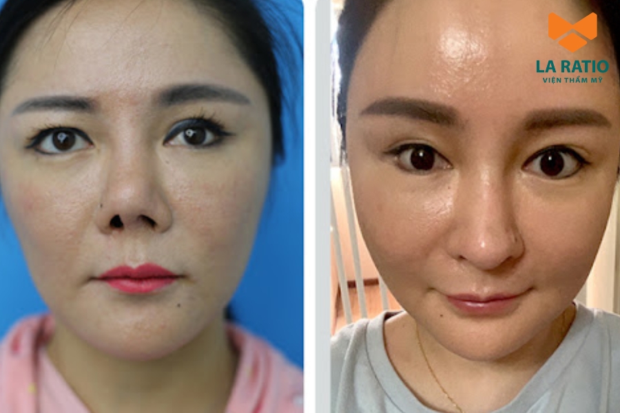 ù mang lại hiệu quả thẩm mỹ cao, cắt mí Trung Hoa vẫn tiềm ẩn một số biến chứng