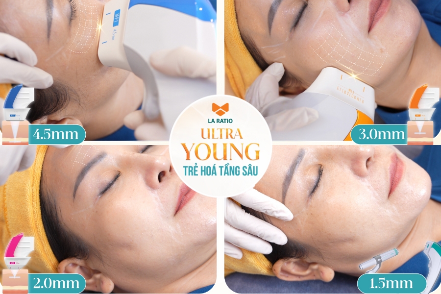 Cơ chế tác động đa tầng của công nghệ Ultraformer MPT, tác động theo chiều sâu da Cơ chế tác động đa tầng của công nghệ Ultraformer MPT, tác động theo chiều sâu da