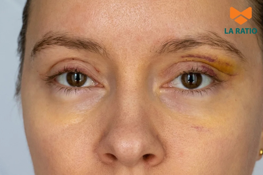 Cắt mí bị sâu là tình trạng nếp mí sau phẫu thuật được tạo quá cao, khiến mắt bị lõm vào Cắt mí bị sâu là tình trạng nếp mí sau phẫu thuật được tạo quá cao, khiến mắt bị lõm vào