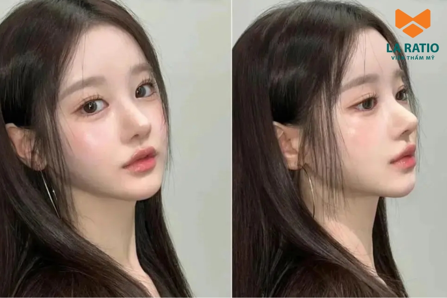 Cắt mí Trung Hoa tạo hiệu ứng “giọt lệ” giúp đôi mắt to, long lanh và đầy cuốn hút